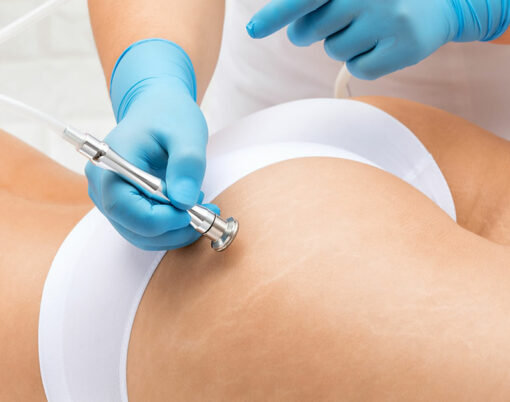 A beautician makes a microdermabrasion procedure to remove stretch marks on the thighs of a young woman.