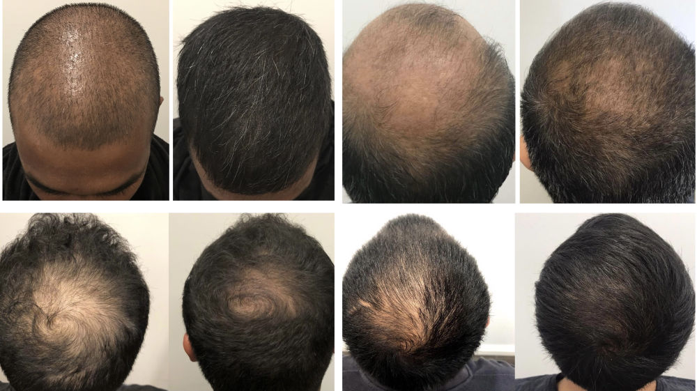 hair loss treatment - before and after